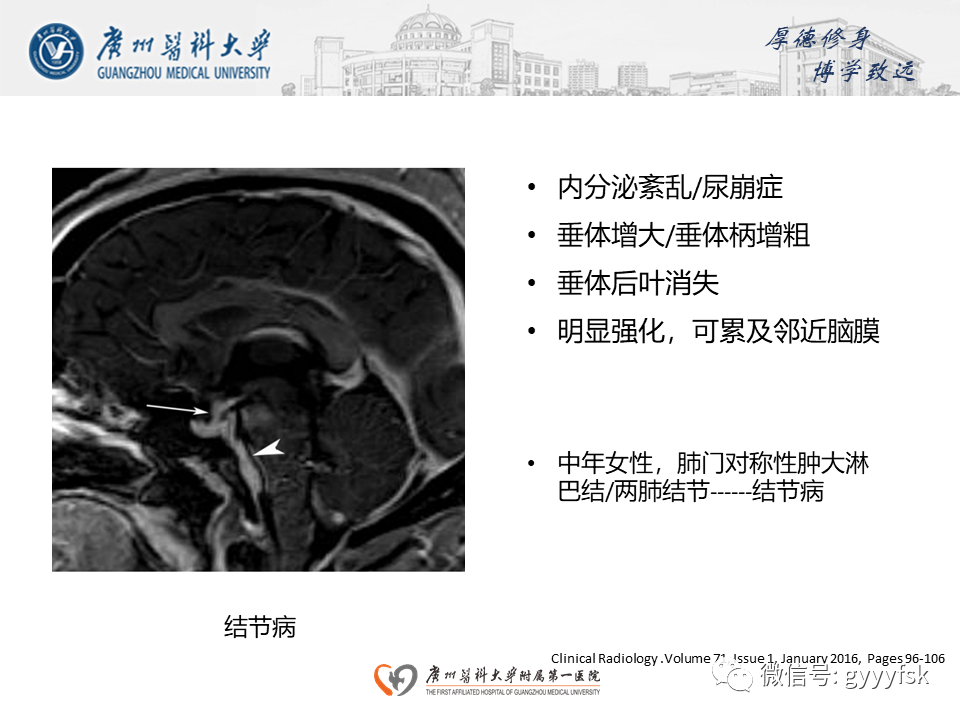 影像PPT - 【PPT】朗格汉斯细胞组织细胞增生症系统性影像表现-40