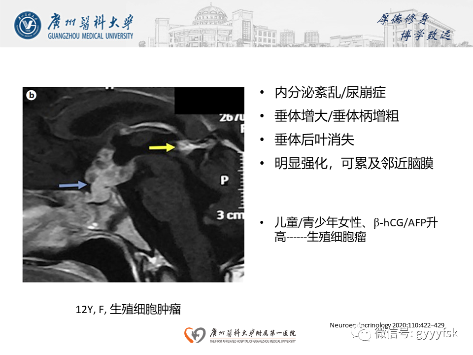 影像PPT - 【PPT】朗格汉斯细胞组织细胞增生症系统性影像表现-41