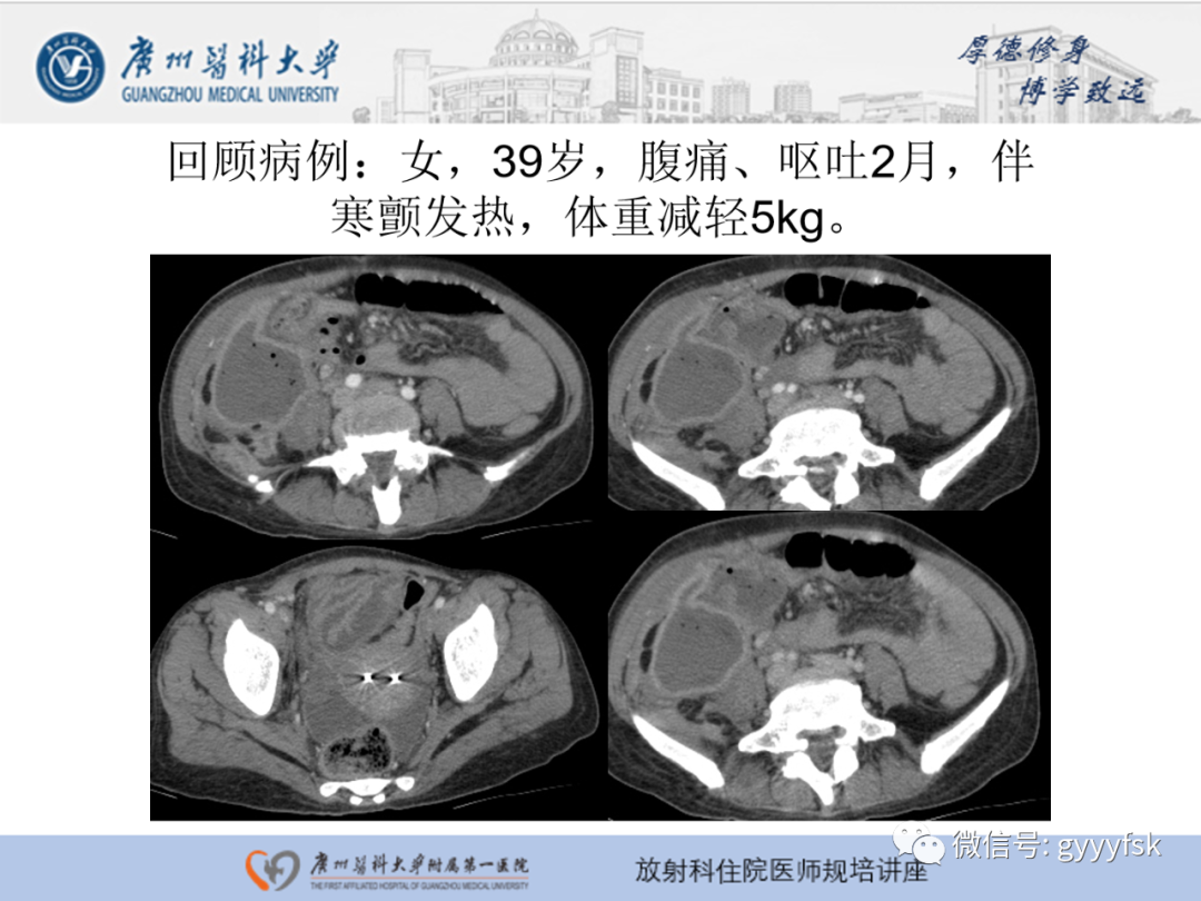 影像PPT - 【PPT】胃肠道造影检查-3