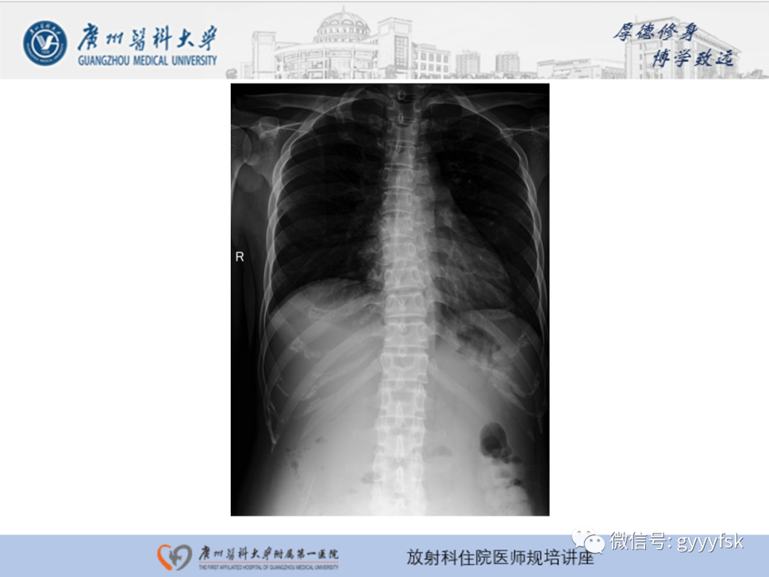 影像PPT - 【PPT】胃肠道造影检查-18