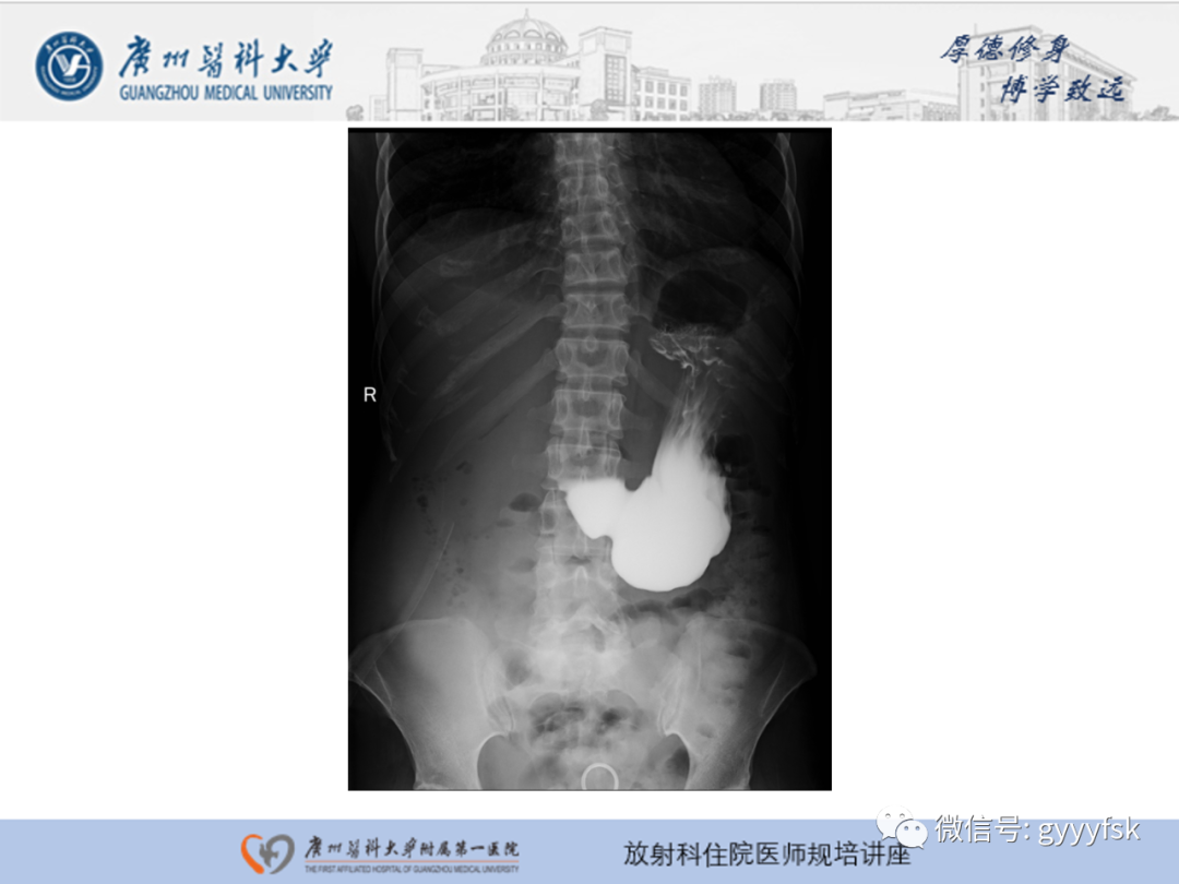 影像PPT - 【PPT】胃肠道造影检查-20