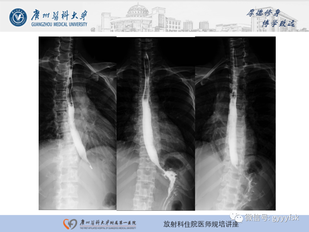 影像PPT - 【PPT】胃肠道造影检查-19