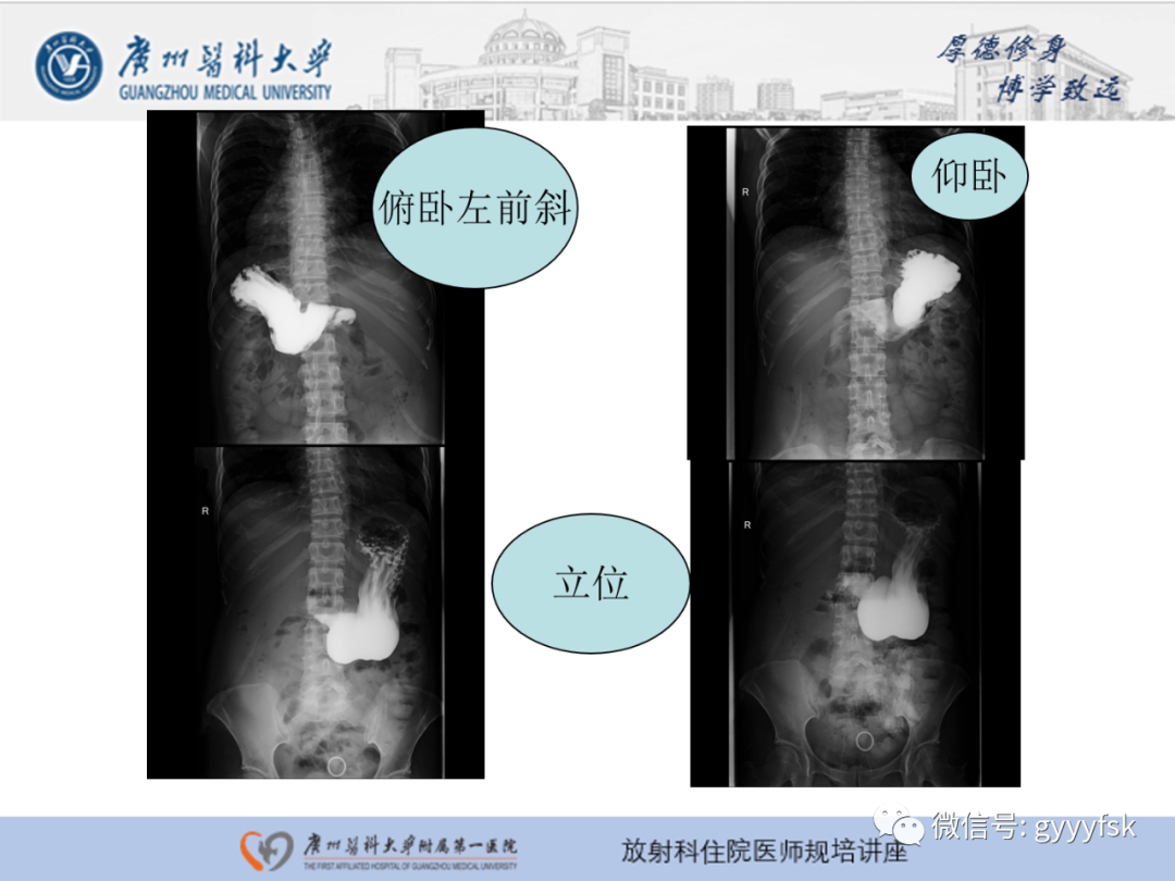 影像PPT - 【PPT】胃肠道造影检查-22