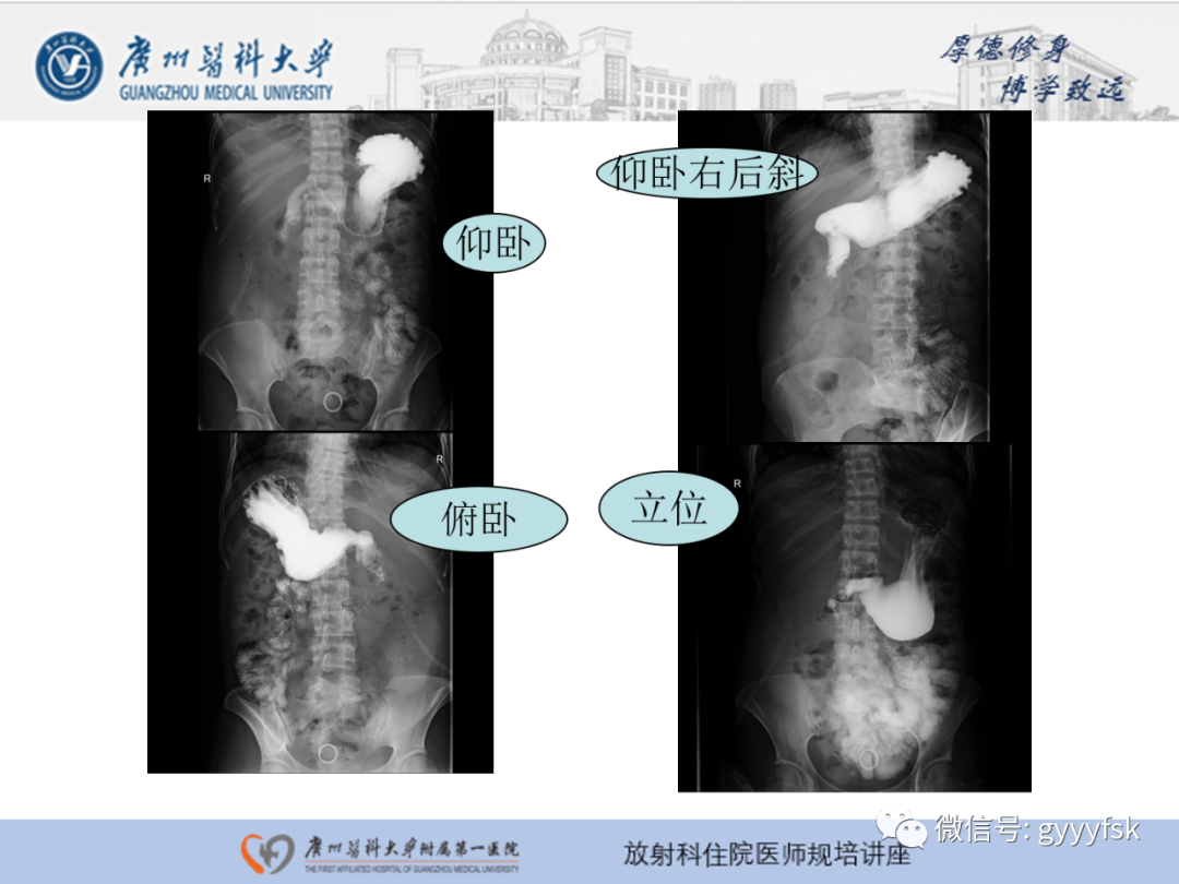 影像PPT - 【PPT】胃肠道造影检查-24