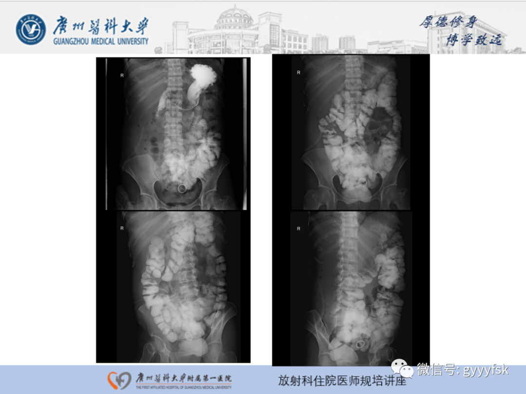 影像PPT - 【PPT】胃肠道造影检查-25