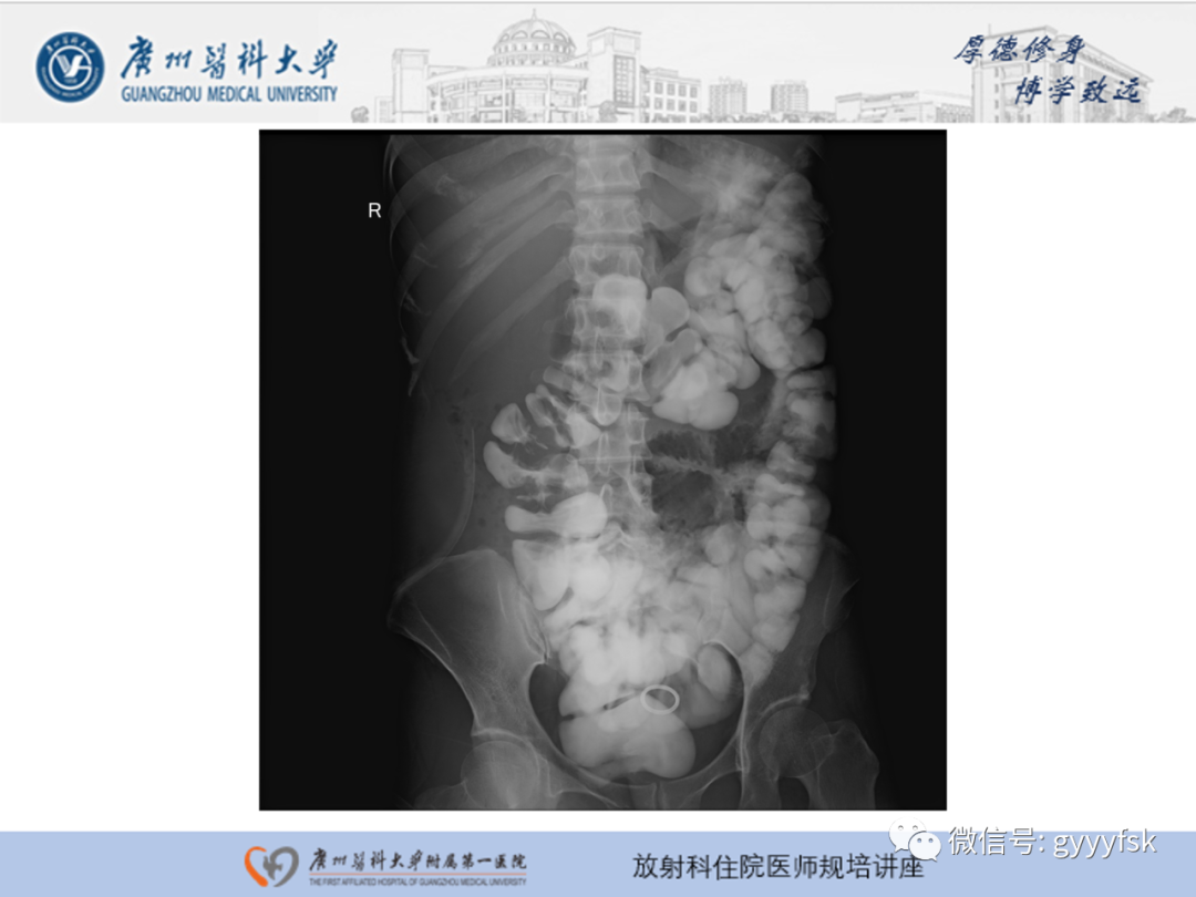 影像PPT - 【PPT】胃肠道造影检查-26