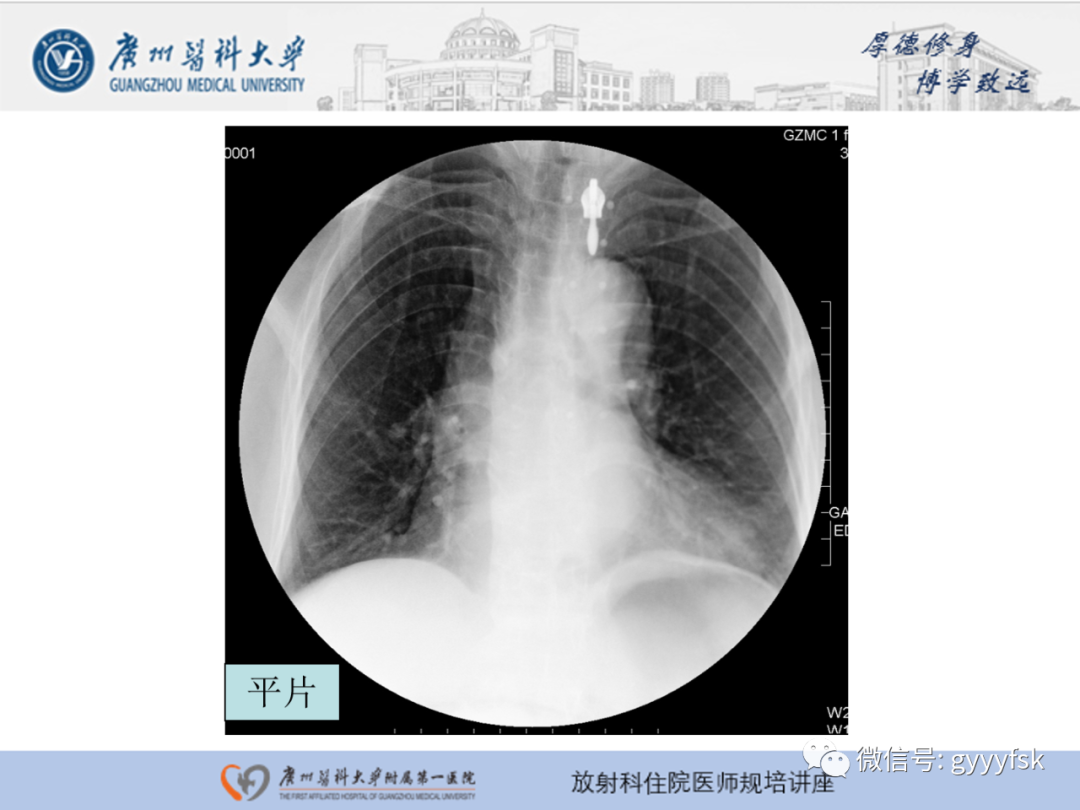 影像PPT - 【PPT】胃肠道造影检查-29