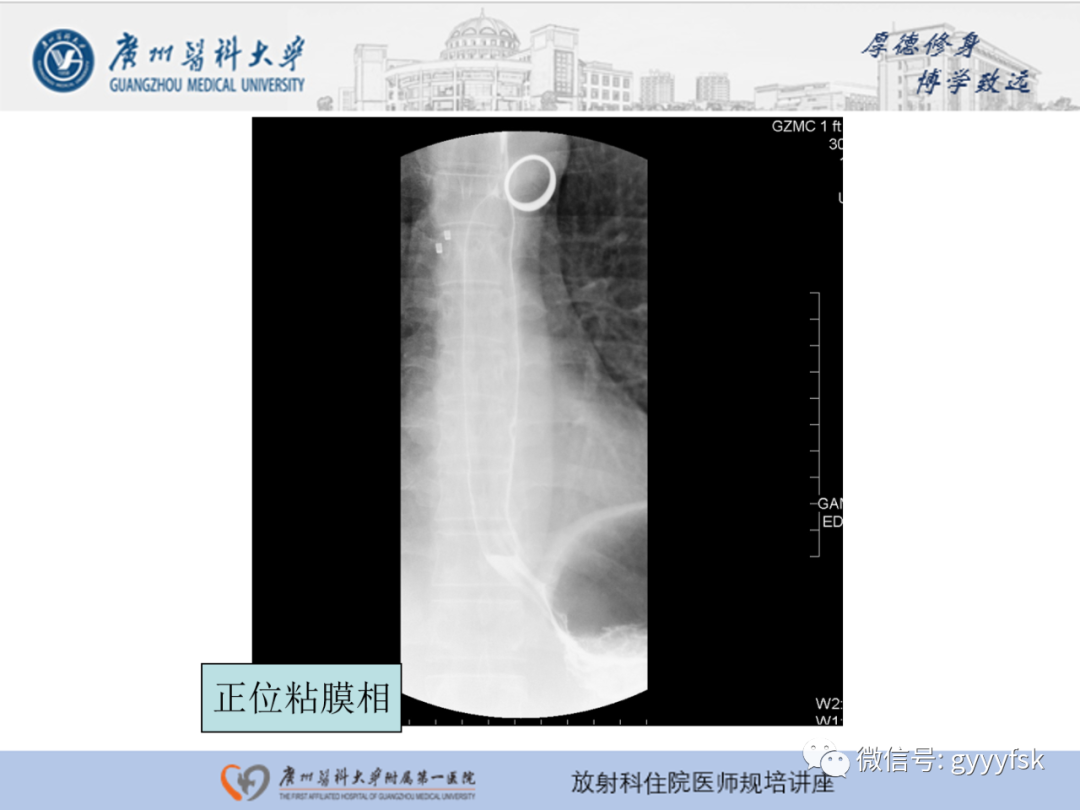 影像PPT - 【PPT】胃肠道造影检查-30