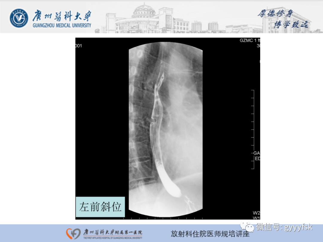 影像PPT - 【PPT】胃肠道造影检查-31