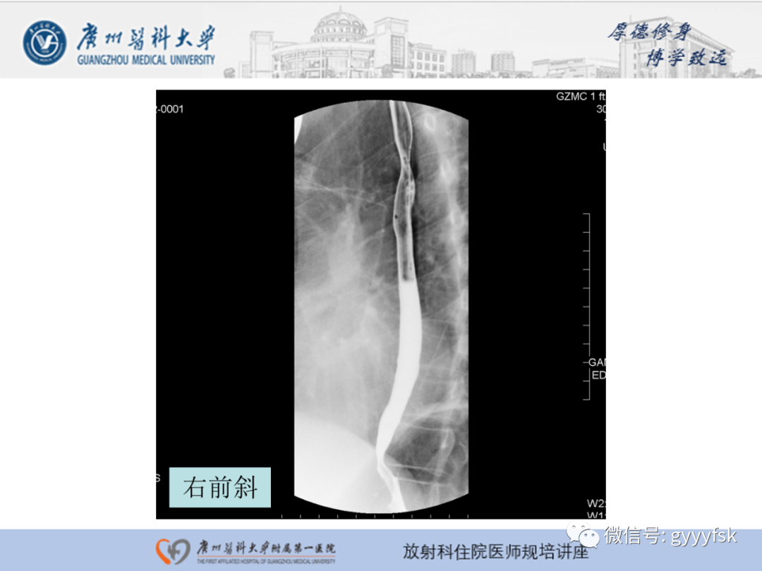 影像PPT - 【PPT】胃肠道造影检查-32