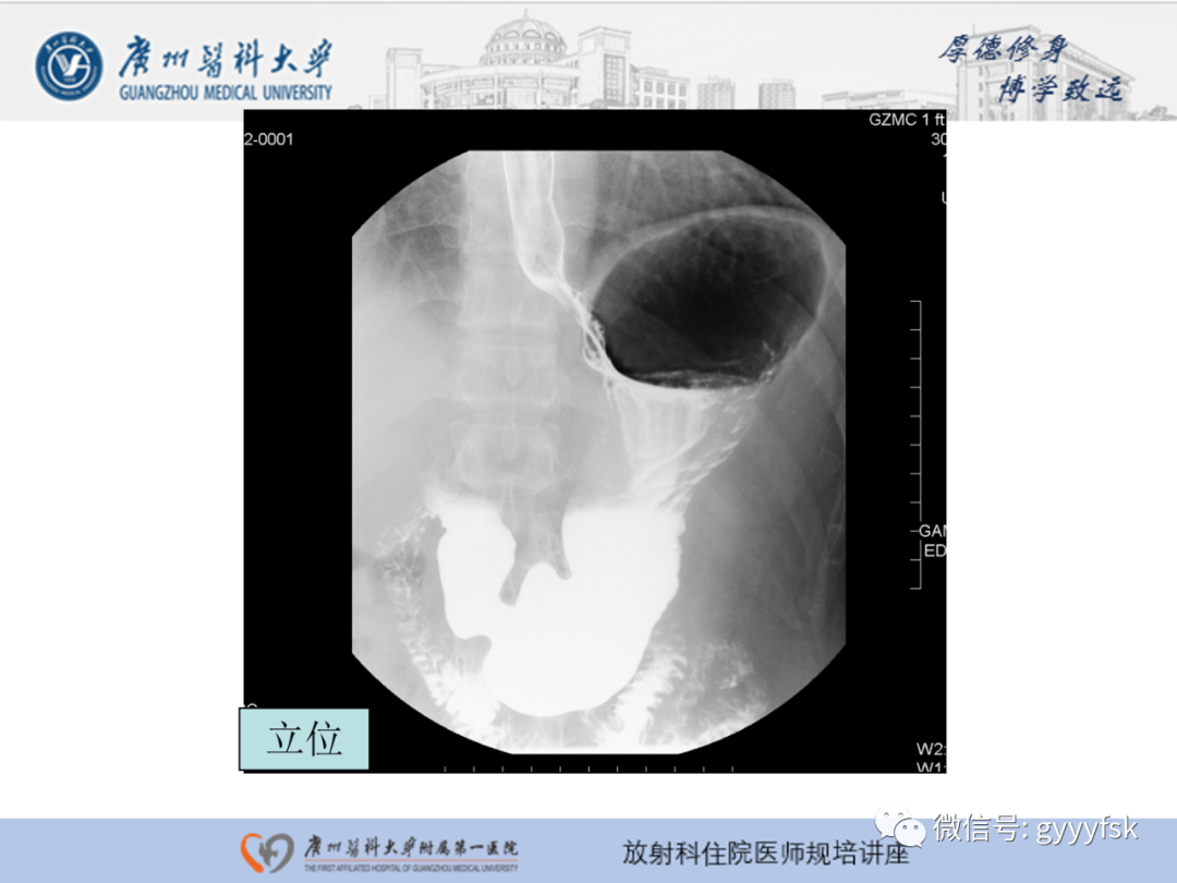 影像PPT - 【PPT】胃肠道造影检查-33