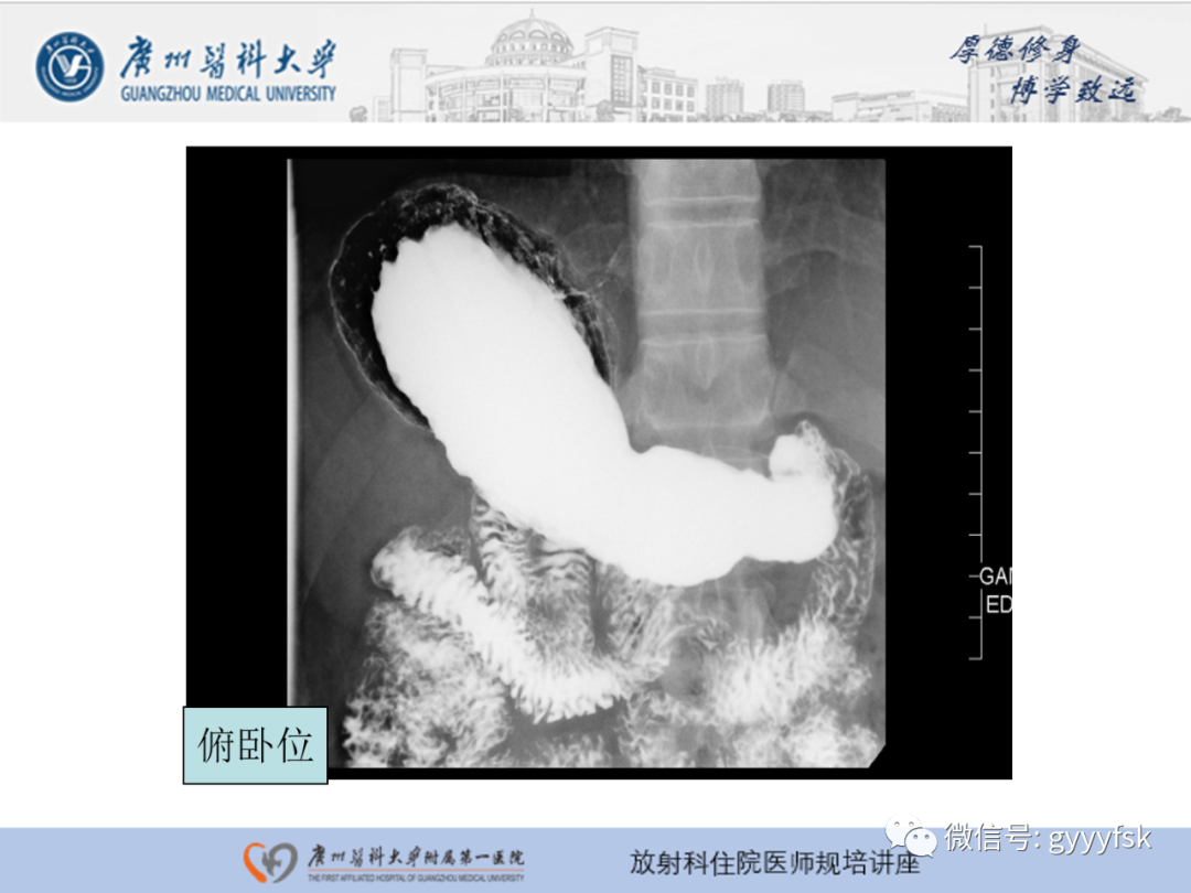 影像PPT - 【PPT】胃肠道造影检查-34