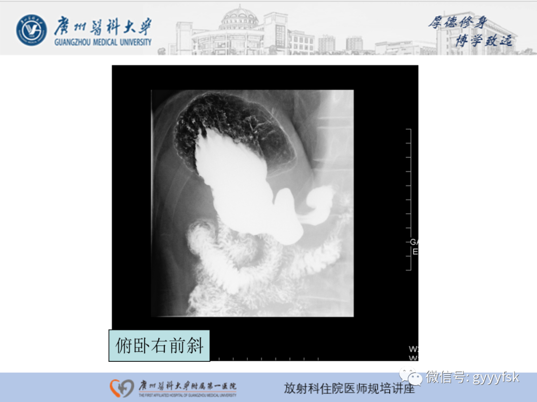 影像PPT - 【PPT】胃肠道造影检查-35
