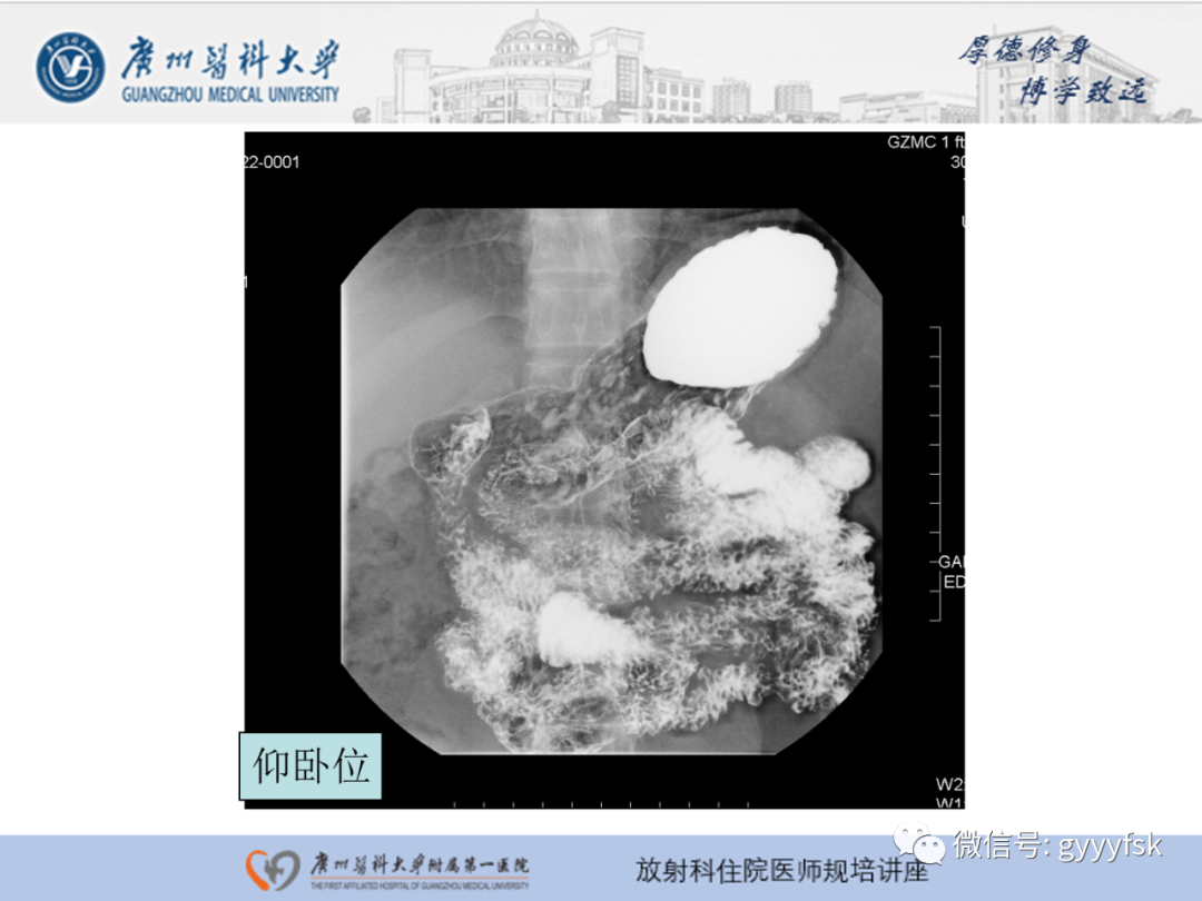 影像PPT - 【PPT】胃肠道造影检查-36