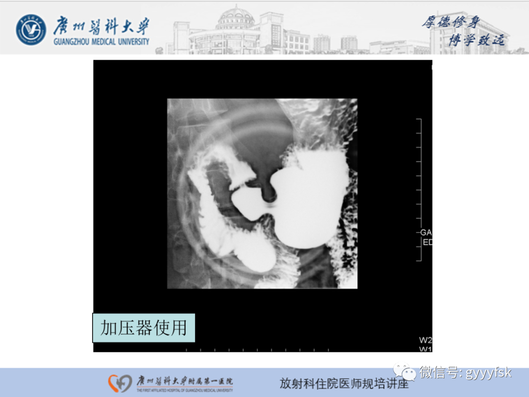 影像PPT - 【PPT】胃肠道造影检查-37