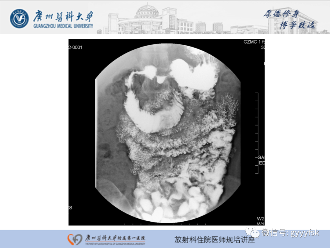 影像PPT - 【PPT】胃肠道造影检查-39