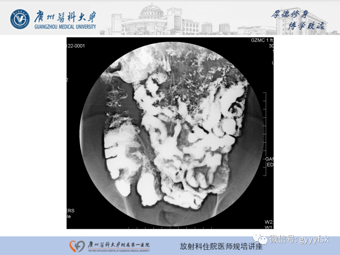 影像PPT - 【PPT】胃肠道造影检查-41