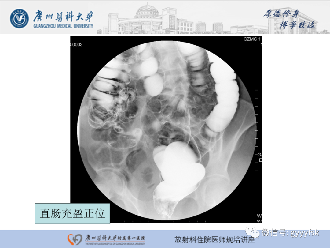 影像PPT - 【PPT】胃肠道造影检查-44