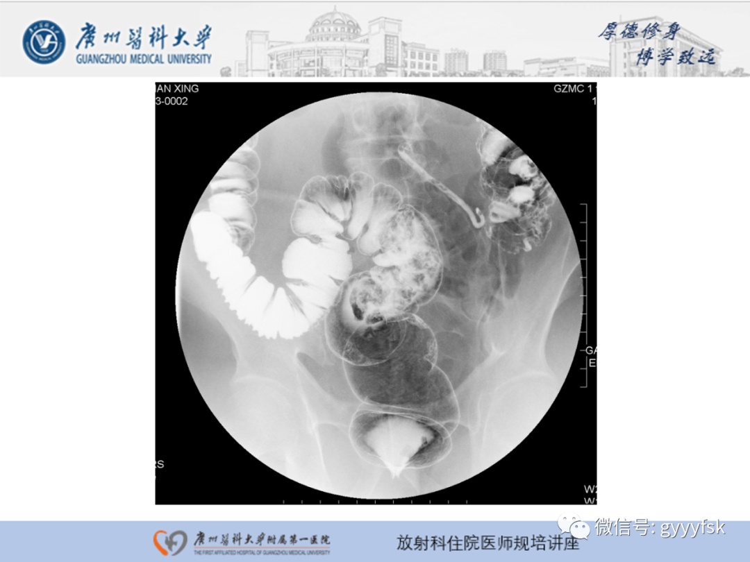 影像PPT - 【PPT】胃肠道造影检查-45