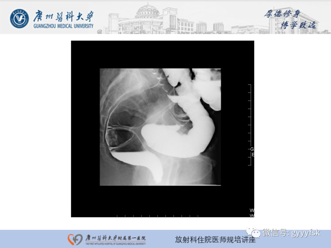 影像PPT - 【PPT】胃肠道造影检查-47
