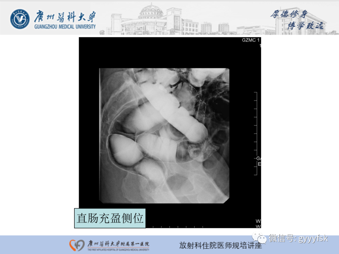 影像PPT - 【PPT】胃肠道造影检查-46