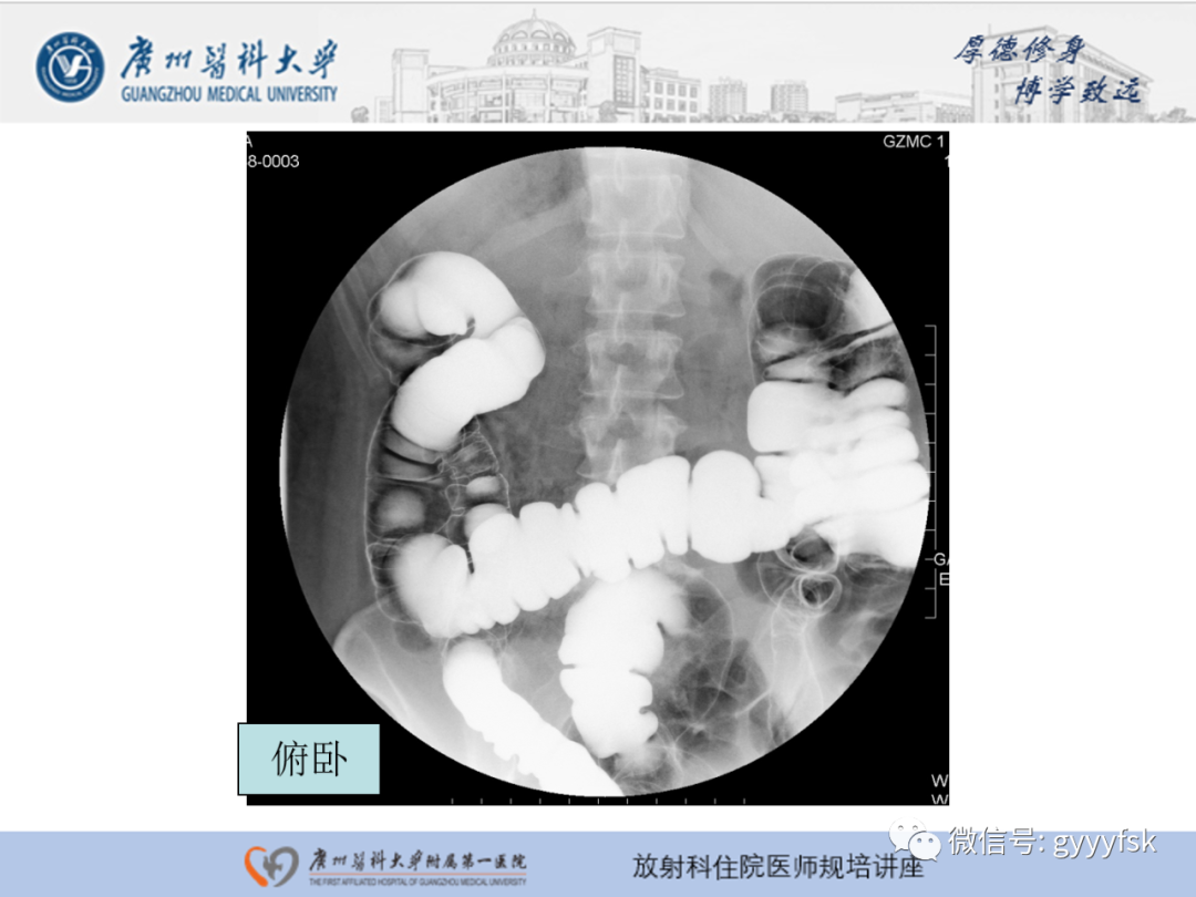 影像PPT - 【PPT】胃肠道造影检查-48