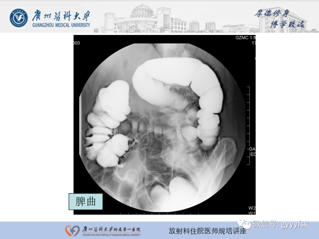 影像PPT - 【PPT】胃肠道造影检查-49