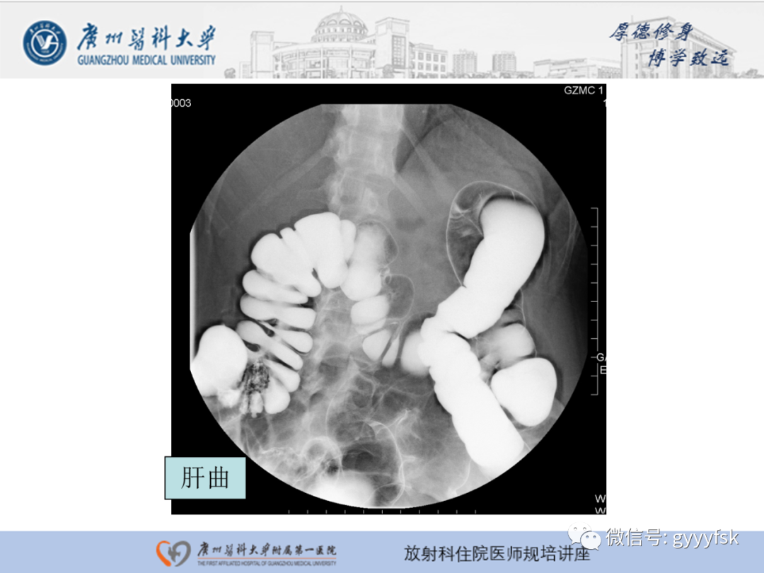 影像PPT - 【PPT】胃肠道造影检查-50
