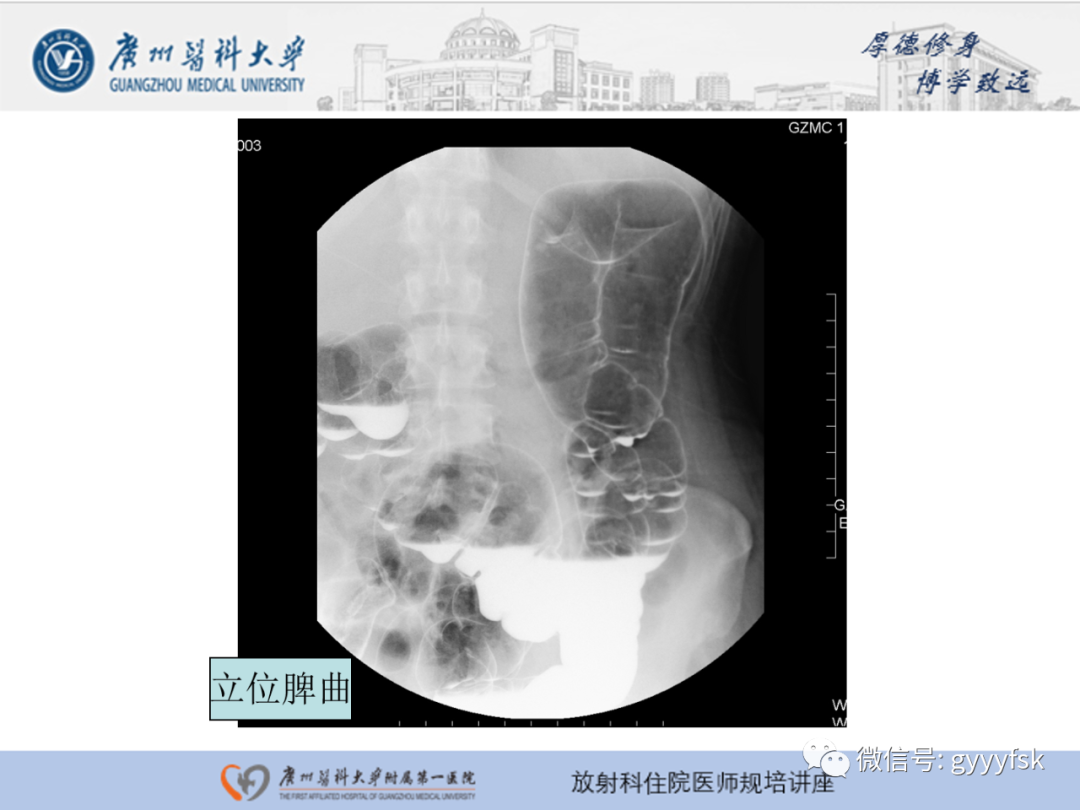 影像PPT - 【PPT】胃肠道造影检查-51
