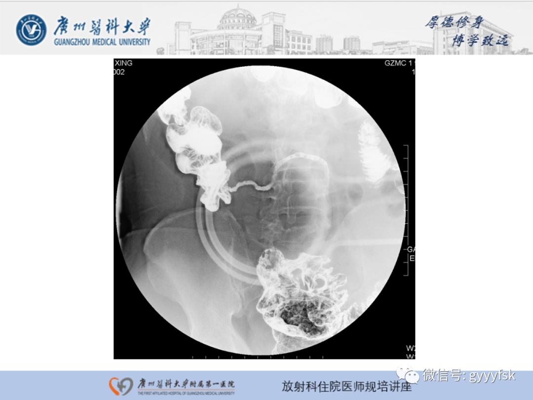 影像PPT - 【PPT】胃肠道造影检查-54