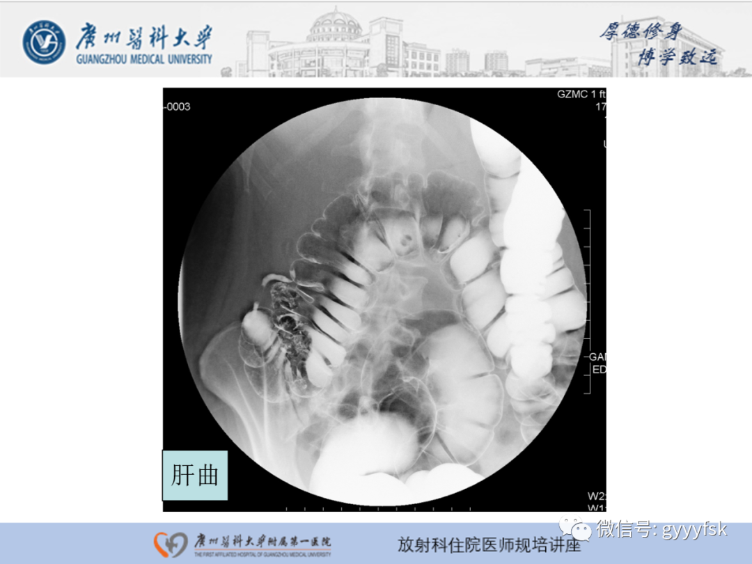 影像PPT - 【PPT】胃肠道造影检查-53