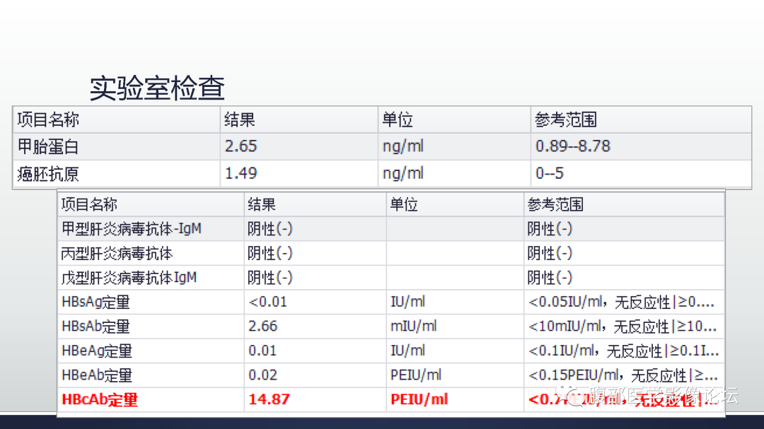 影像PPT - 【病例】多中心肝细胞肝癌HCC一例CT影像-5