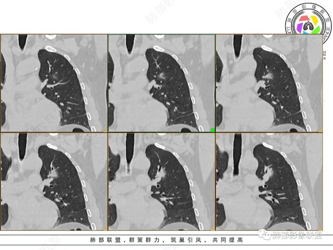 影像PPT - 【病例】三年逐渐增大的混合磨玻璃结节,真相是什么?-10 影像PPT - 【病例】三年逐渐增大的混合磨玻璃结节,真相是什么?-10