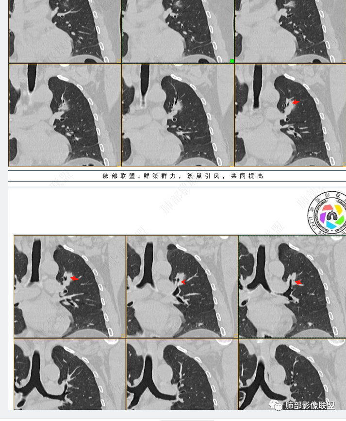 影像PPT - 【病例】三年逐渐增大的混合磨玻璃结节,真相是什么?-23 影像PPT - 【病例】三年逐渐增大的混合磨玻璃结节,真相是什么?-23
