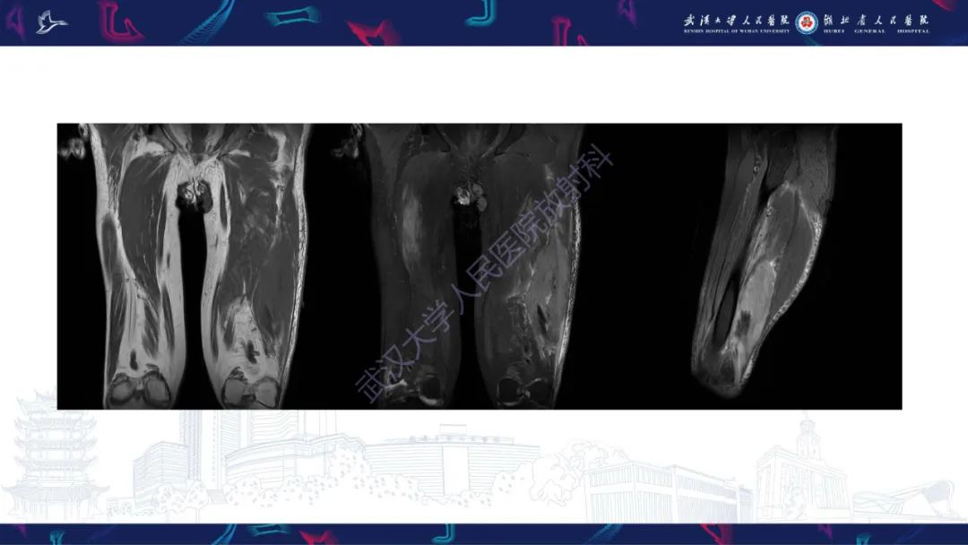 影像PPT - 【PPT】软组织淋巴瘤影像诊断-3