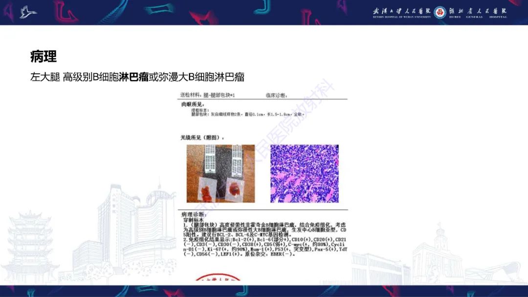 影像PPT - 【PPT】软组织淋巴瘤影像诊断-4