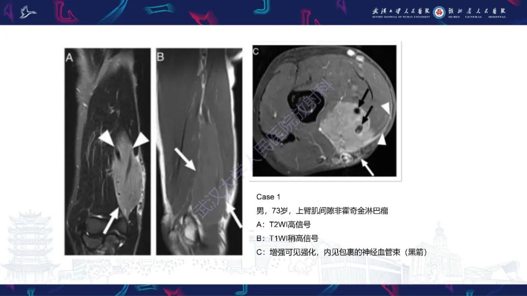 影像PPT - 【PPT】软组织淋巴瘤影像诊断-12