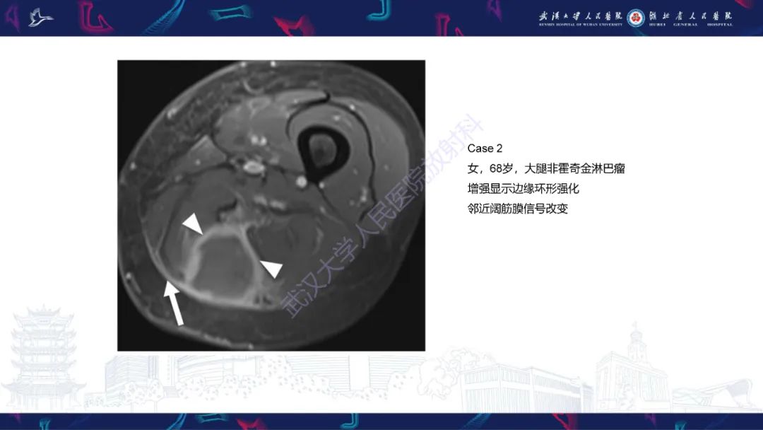 影像PPT - 【PPT】软组织淋巴瘤影像诊断-13