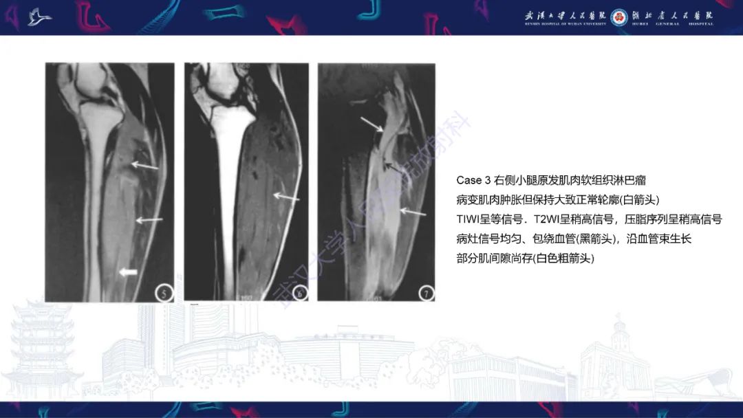 影像PPT - 【PPT】软组织淋巴瘤影像诊断-14