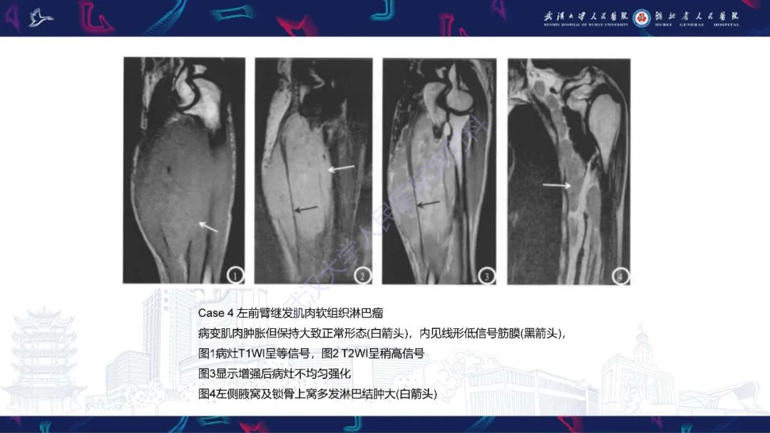 影像PPT - 【PPT】软组织淋巴瘤影像诊断-15
