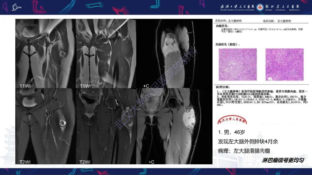 影像PPT - 【PPT】软组织淋巴瘤影像诊断-18