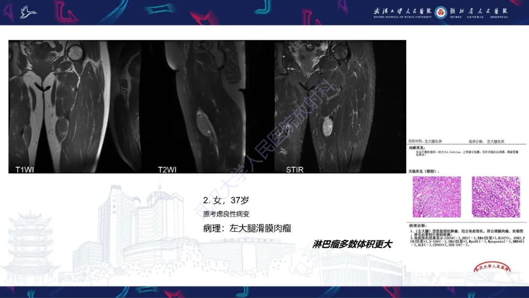 影像PPT - 【PPT】软组织淋巴瘤影像诊断-19