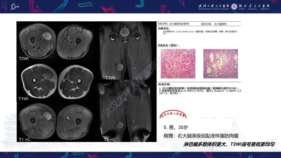 影像PPT - 【PPT】软组织淋巴瘤影像诊断-22