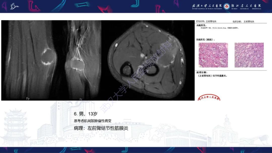 影像PPT - 【PPT】软组织淋巴瘤影像诊断-23