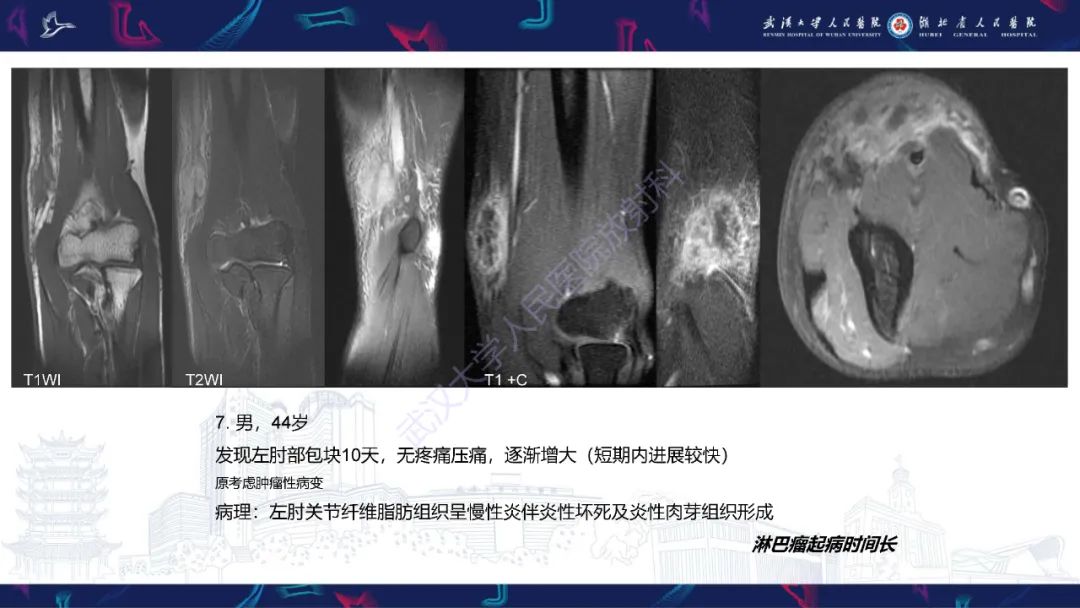 影像PPT - 【PPT】软组织淋巴瘤影像诊断-24
