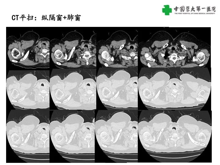 影像PPT - 【病例】气管腺样囊性癌1例CT影像-3