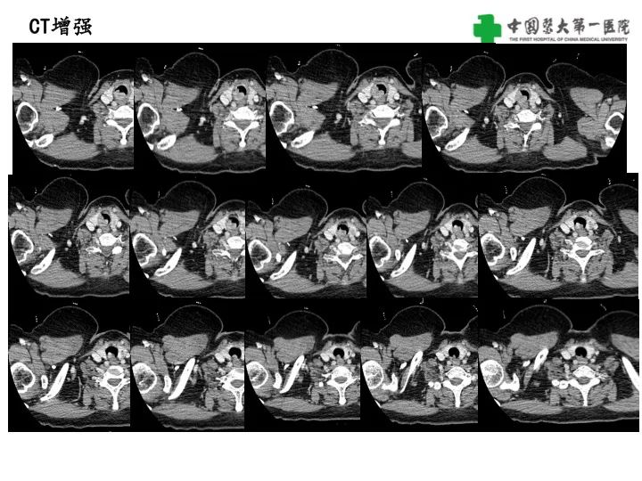影像PPT - 【病例】气管腺样囊性癌1例CT影像-4