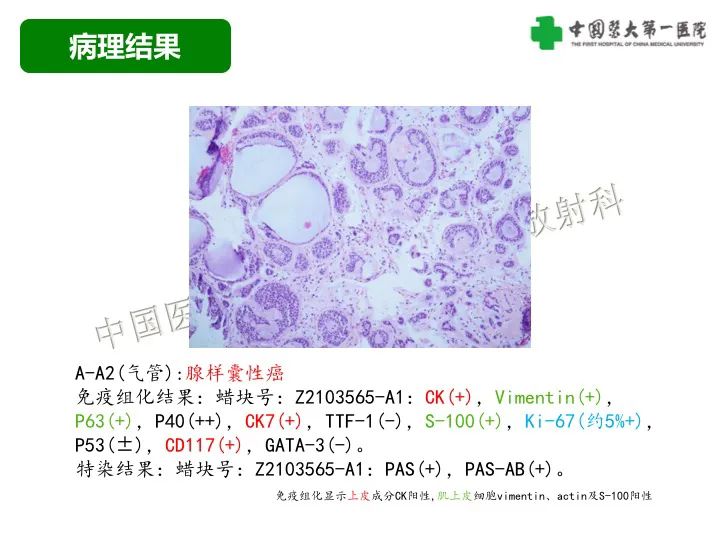 影像PPT - 【病例】气管腺样囊性癌1例CT影像-7