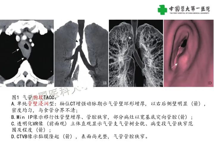 影像PPT - 【病例】气管腺样囊性癌1例CT影像-12