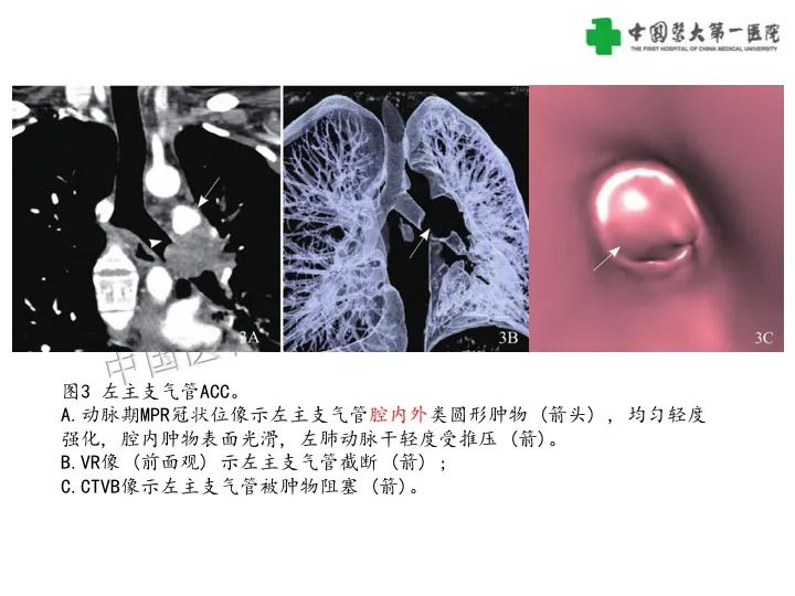 影像PPT - 【病例】气管腺样囊性癌1例CT影像-13